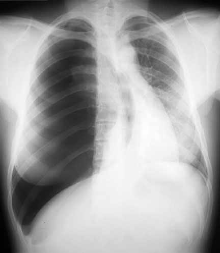 Tension-type pneumothorax