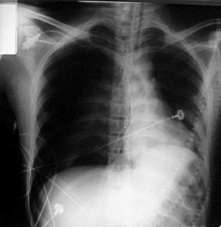 Tension-type Pneumothorax