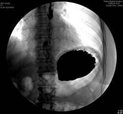 Cascade stomach 2