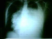 Chest x-ray