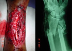 Type IIIB open fracture - 1