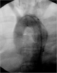 Flouroscopy - Stent