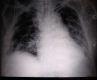 Post-op chest x-ray