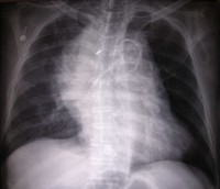 Initial chest x-ray