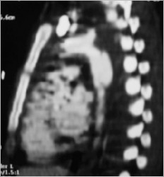 CT Scan - Aortic rupture