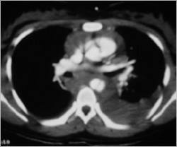 CT Scan - Aortic Rupture