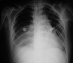Postoperatory Chest X-ray