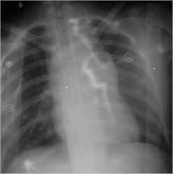 Initial Chest X-Ray