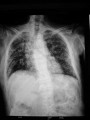 cxr