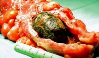 Gallstone Ileus