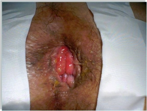 hemorrhoidal prolapse