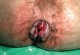 hemorrhoidal prolapse