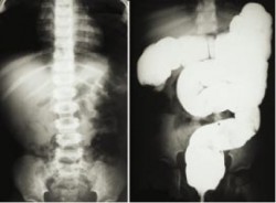 Intussusception. Plain film and barium enema