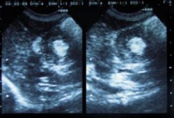 Intussusception. Ultrasound