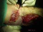 wound infection