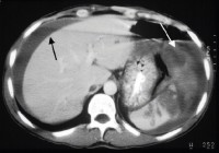 Spleen Injury and Hemoperitoneum