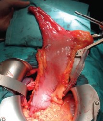 Tubulization of stomach